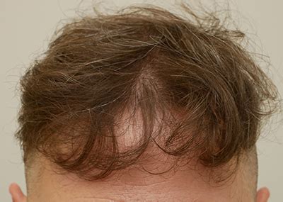 mens hair restoration st louis|Hair Transplant Expert in Kirkwood .